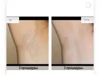 Лазерная эпиляция, воск и шугаринг, фотография 3
