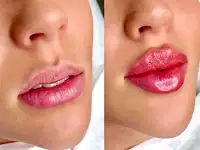 Врач Косметолог. Ботокс, Нити, Губы, фотография 6