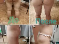 Антицеллюлитный массаж, фотография 5