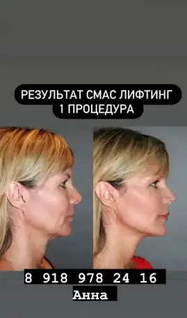 smas лифтинг для лица и тела, фотография 2