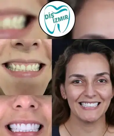 Go To Smile (СТОМАТОЛОГИЧЕСКИЙ ТУРИЗМ) (эстетическая стоматогия в Турции), фотография 4