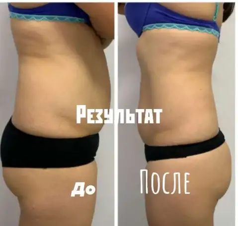 Услуги lpg  массажа, фотография 1