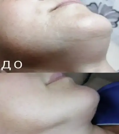 Омоложение лица без операций, фотография 4