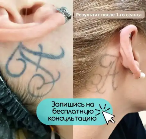 Лазерное удаление татуировок и татуажа/перманента, фотография 3