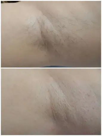Услуги шугаринга, фотография 1