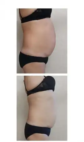 Смас лифтинг по телу, фотография 3