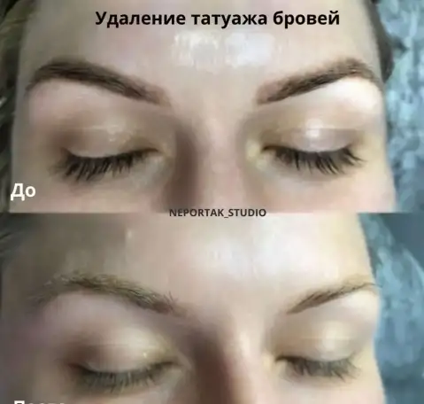 Лазерное удаление татуировок и татуажа/перманента, фотография 6