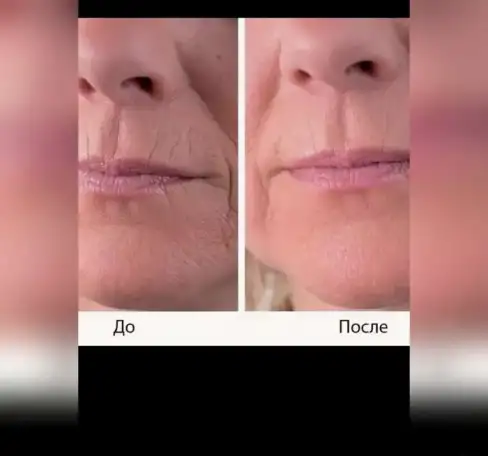 Эффективное омоложение, фотография 3