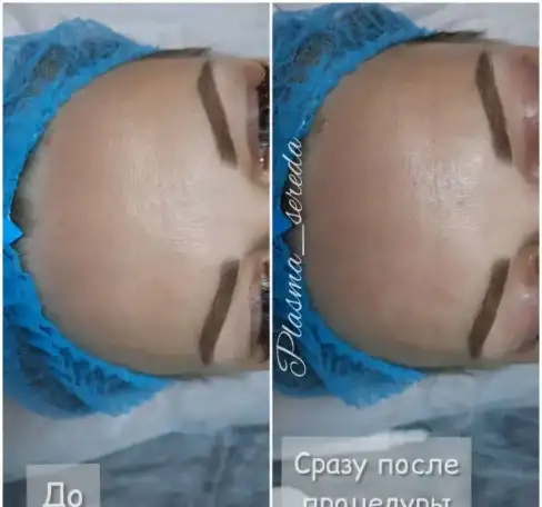 Холодная плазма омоложение лица, фотография 3