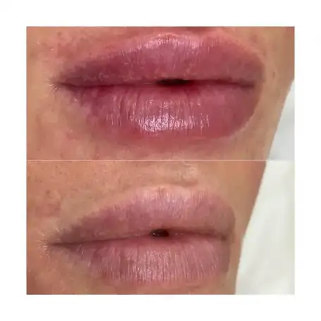 Увеличение губ, Juviderm Smile,0,55 ml, фотография 1