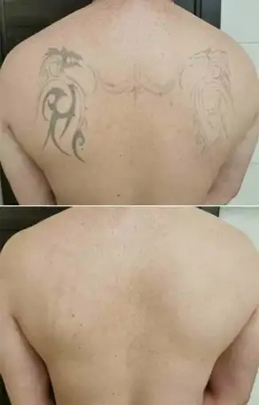Удаление тату и татуажа, фотография 4