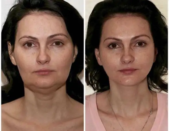 Смас лифтинг в Москве., фотография 4