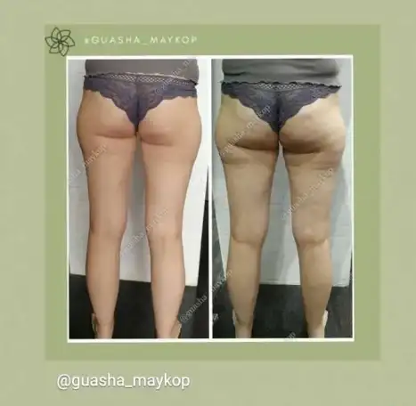 Массаж Гуаша тела и лица, коррекция фигуры, фотография 2