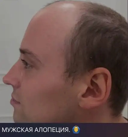 Замещение волос, фотография 10