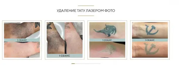 Безболезненное удаление татуировок лазером от 1000 рублей, фотография 2