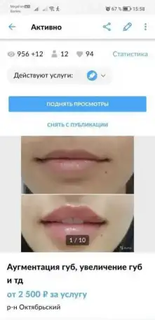 Увеличение губ, моно нити, коги, фотография 3