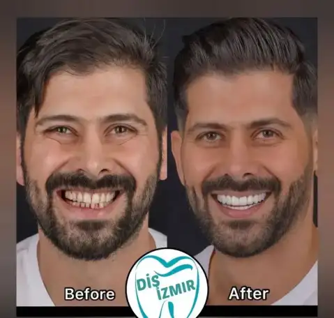 Go To Smile (СТОМАТОЛОГИЧЕСКИЙ ТУРИЗМ) (эстетическая стоматогия в Турции), фотография 7