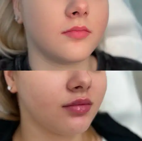 Увеличение губ, фотография 7