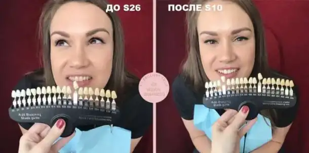Косметическое отбеливание зубов, фотография 3