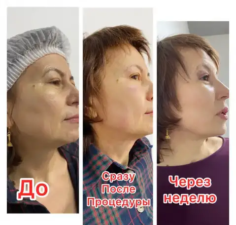 smas лифтинг для лица и тела, фотография 4