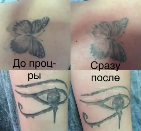 удаление тату, фотография 1