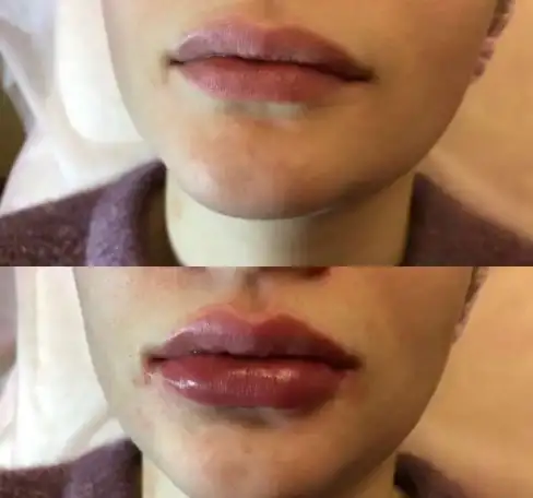 Увеличение губ, фотография 1