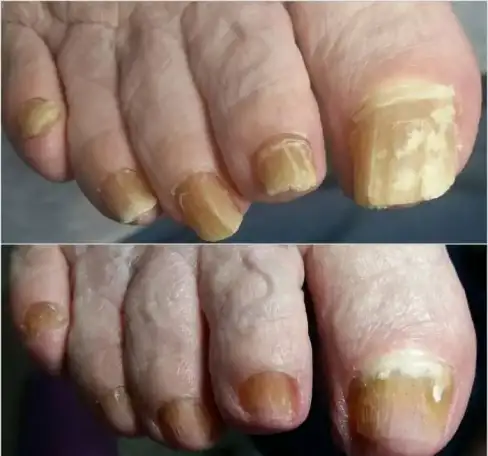 Медицинский педикюр, фотография 3