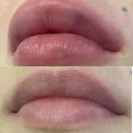 Увеличение губ, Juviderm Smile,0,55 ml, фотография 3