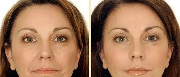 Нити Aptos. Лифтинг. ПОДТЯЖКА лица без операций., фотография 9