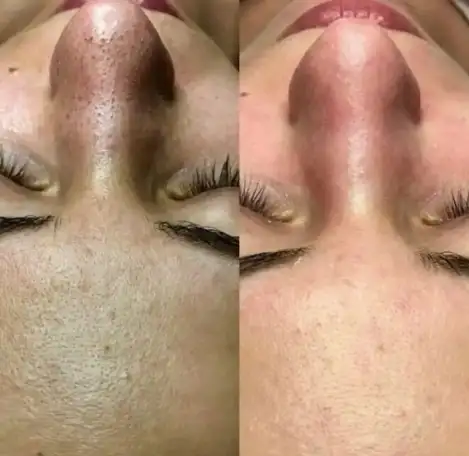 Косметологическая чистка лица, фотография 1