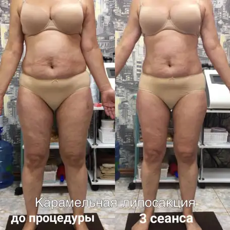 Коррекция фигуры. Липосакция карамельная. Лифтинг, фотография 2