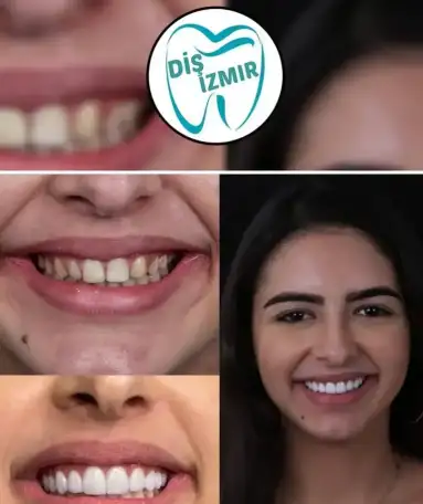 Go To Smile (СТОМАТОЛОГИЧЕСКИЙ ТУРИЗМ) (эстетическая стоматогия в Турции), фотография 3