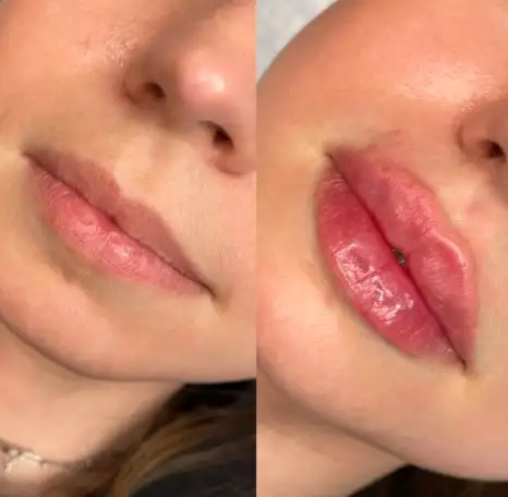 Увеличение губ, фотография 5