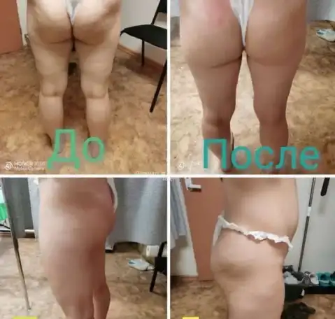 Антицеллюлитный массаж, фотография 5