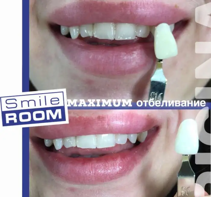 Косметическое отбеливание зубов, фотография 1