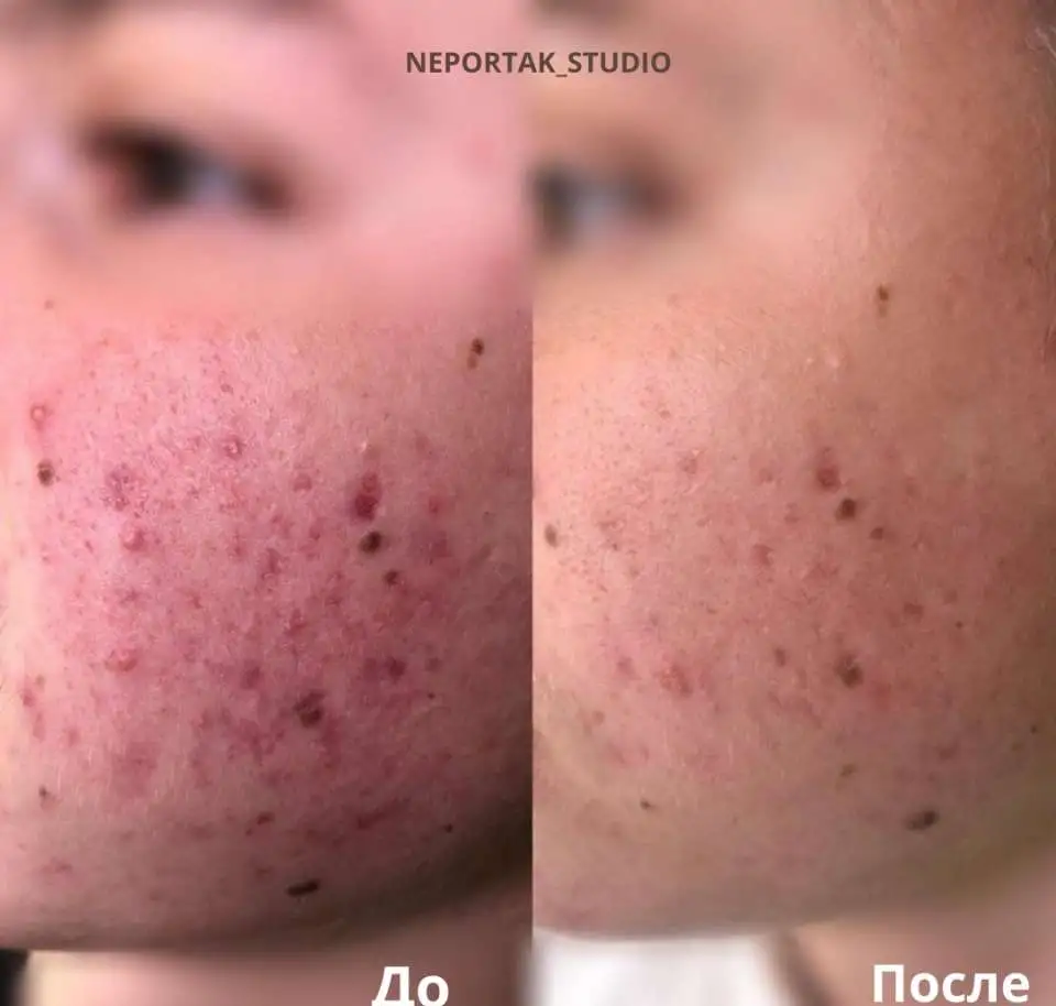Карбоновый пилинг, фотография 4