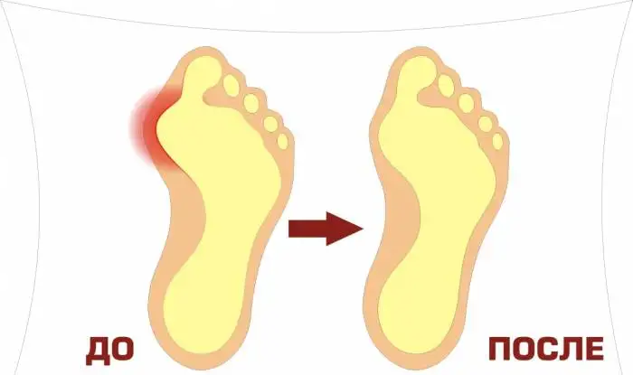 Избавьтесь от подагры с помощью Valgus Pro, фотография 3