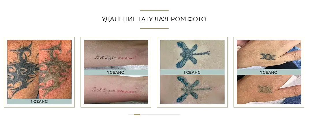Безболезненное удаление татуировок лазером от 1000 рублей, фотография 3