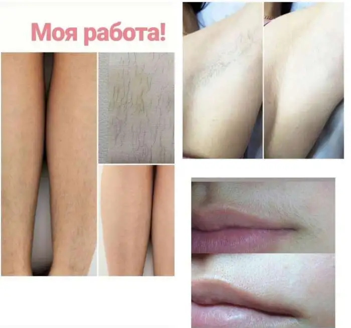 Гелевая эпиляция Let's Gel, фотография 2