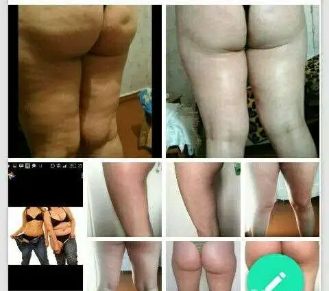Коррекция фигуры антицеллюлитный массаж, фотография 2