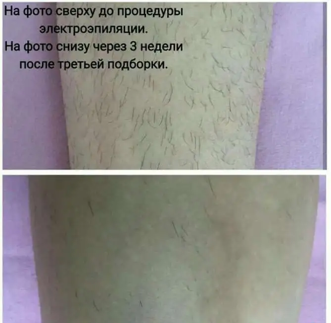 Электроэпиляция с выездом на дом!!!!, фотография 2