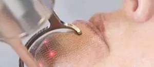 Лазерная эпиляция криолиполиз СПБ, фотография 8