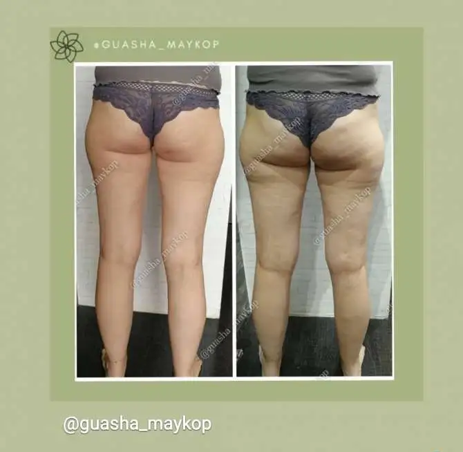 Массаж Гуаша тела и лица, коррекция фигуры, фотография 2