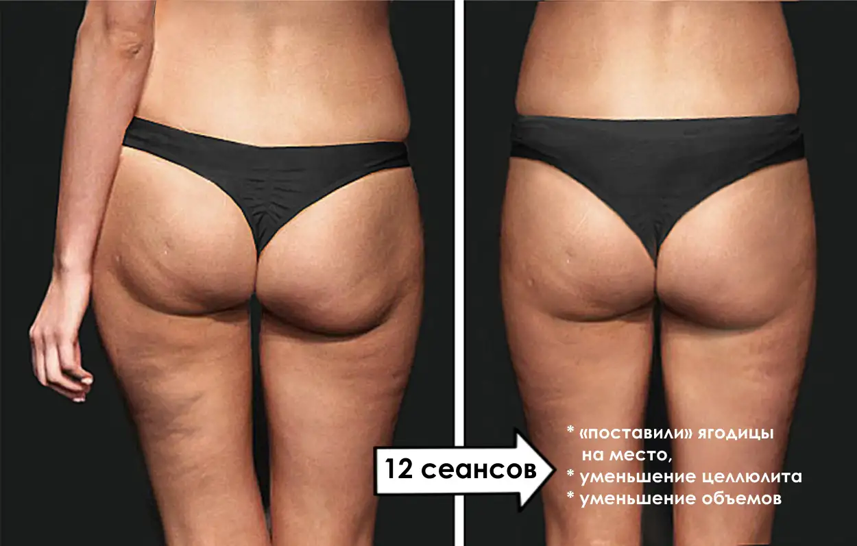 Вакуумно-роликовый и баночный массаж, фотография 5