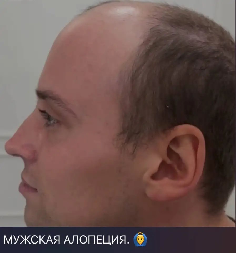 Замещение волос, фотография 10