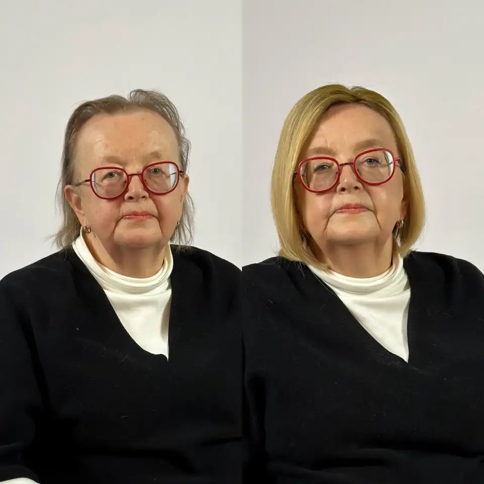 Замещение волос, фотография 5