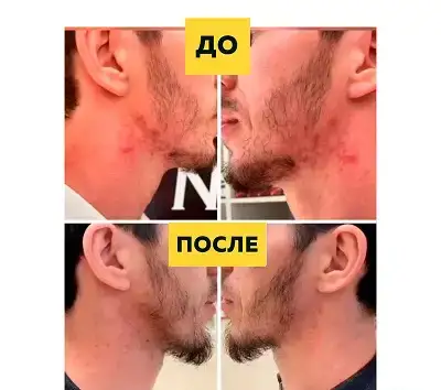 Освободите кожу от прыщей Silver Shein, фотография 6