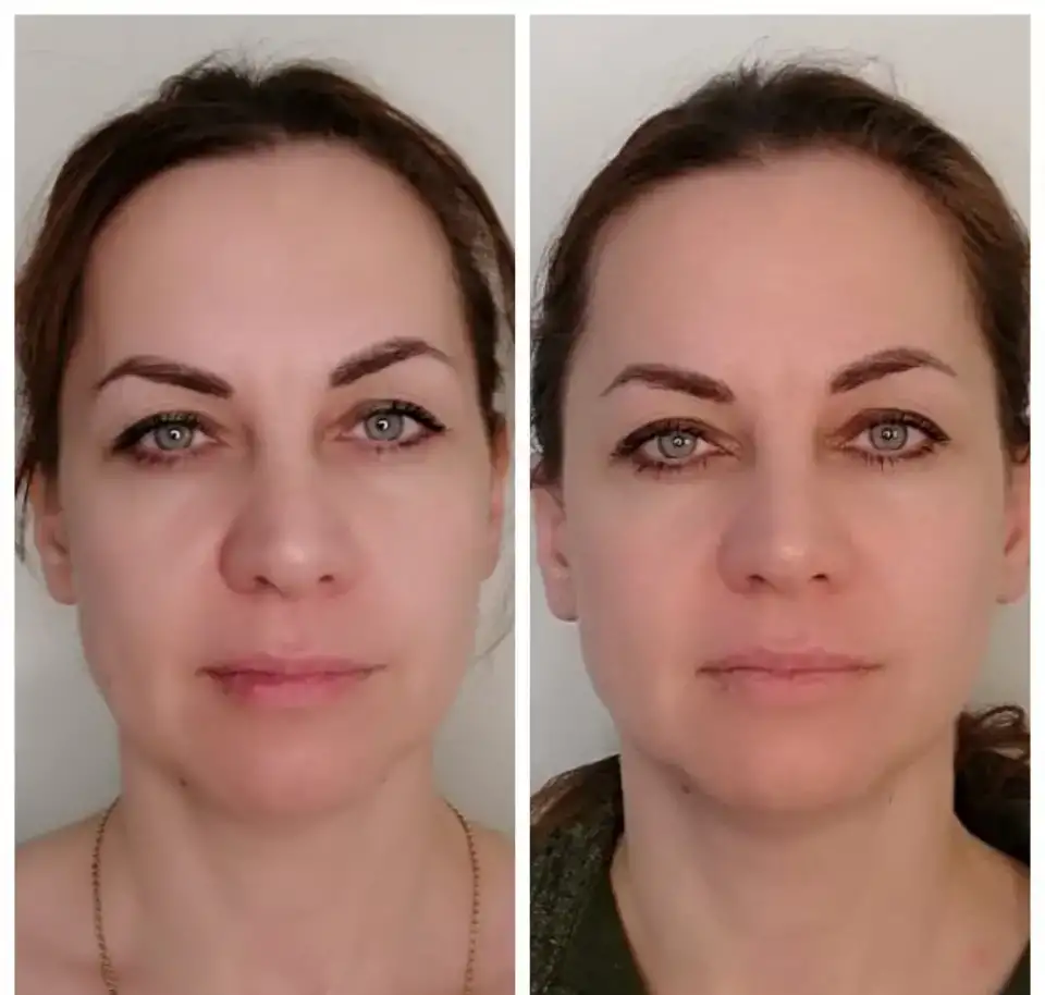Естественное омоложение. Витапластика, фотография 6