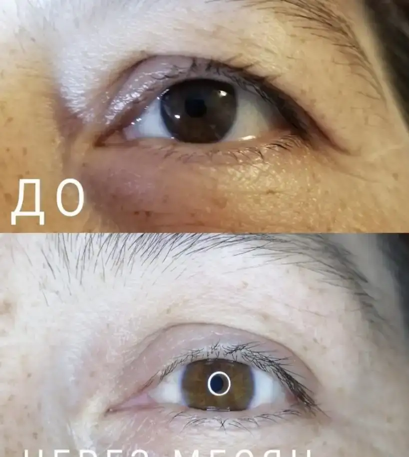 Омоложение лица без операций, фотография 2