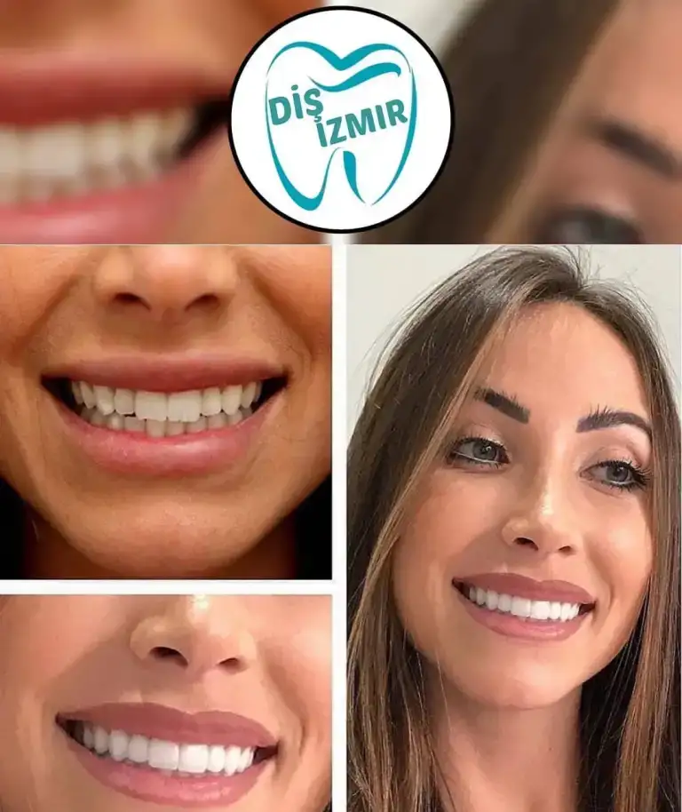 Go To Smile (СТОМАТОЛОГИЧЕСКИЙ ТУРИЗМ) (эстетическая стоматогия в Турции), фотография 6